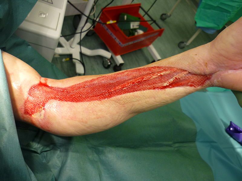 File:Fasciotomy.JPG