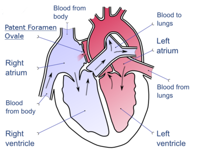 A drawing depicting a patent foramen ovale