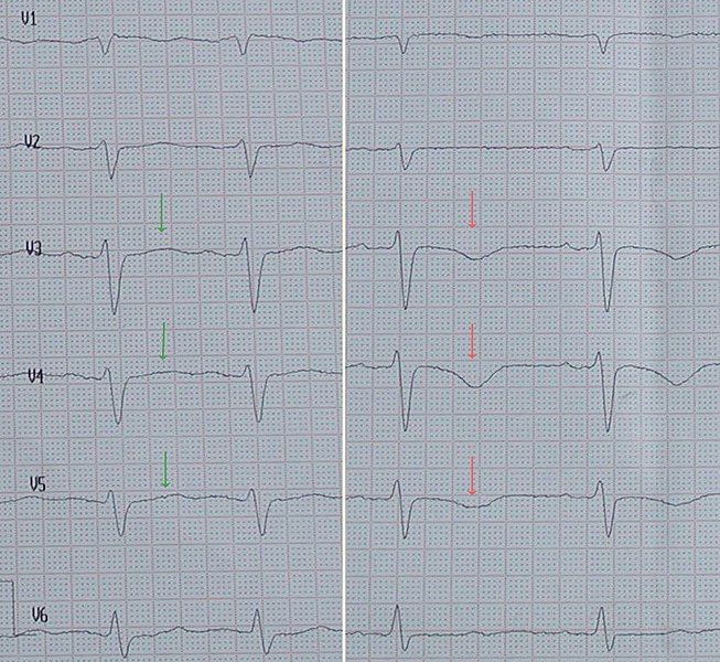 File:ECG tako-tsubo.jpg