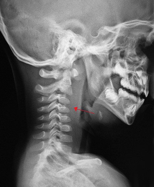 File:Retroabscess10.JPG