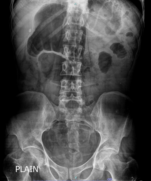 File:Chronic-intestinal-pseudo-obstruction-2.png