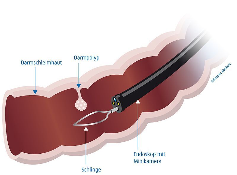 File:Ortenau Klinikum Darmspiegelung.jpg