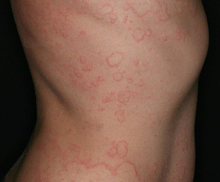 File:Chronic spontaneous urticaria.jpg