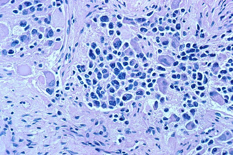 File:Neuroblastoma.jpg