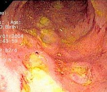 Image of deep ulcers in the colon of a person with Crohn's colitis.