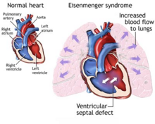 Heart with a ventricular septal defect showing