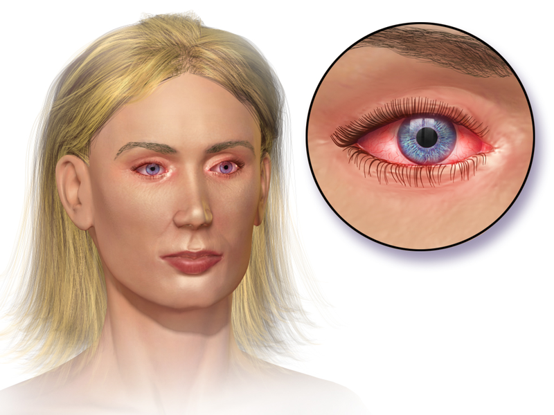 File:Blausen 0013 AllergicConjunctivitis.png