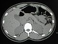 Normal Abdominal CT