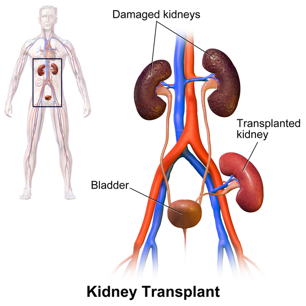 File:Kidney Transplant.png