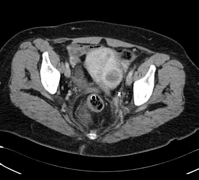 File:Uterine fibroid CT.JPG