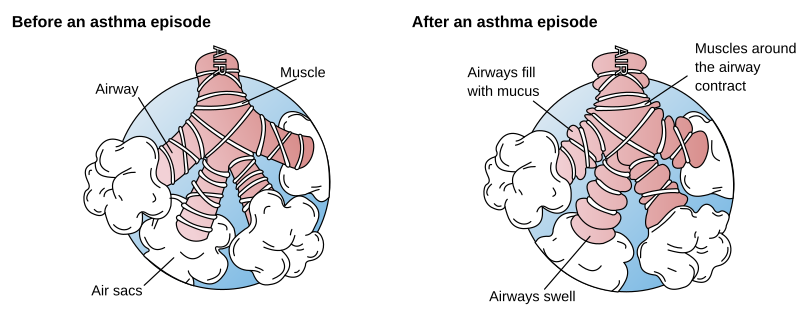 File:Asthma before-after-en.svg