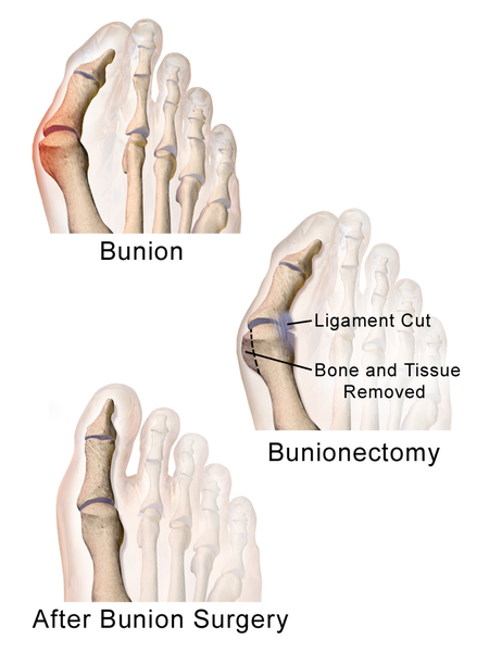 File:Bunionectomy.png