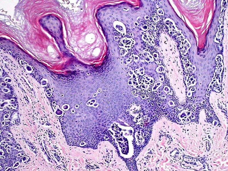 File:Skin Tumors-P9071281.jpg