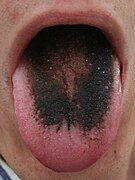 Black tongue