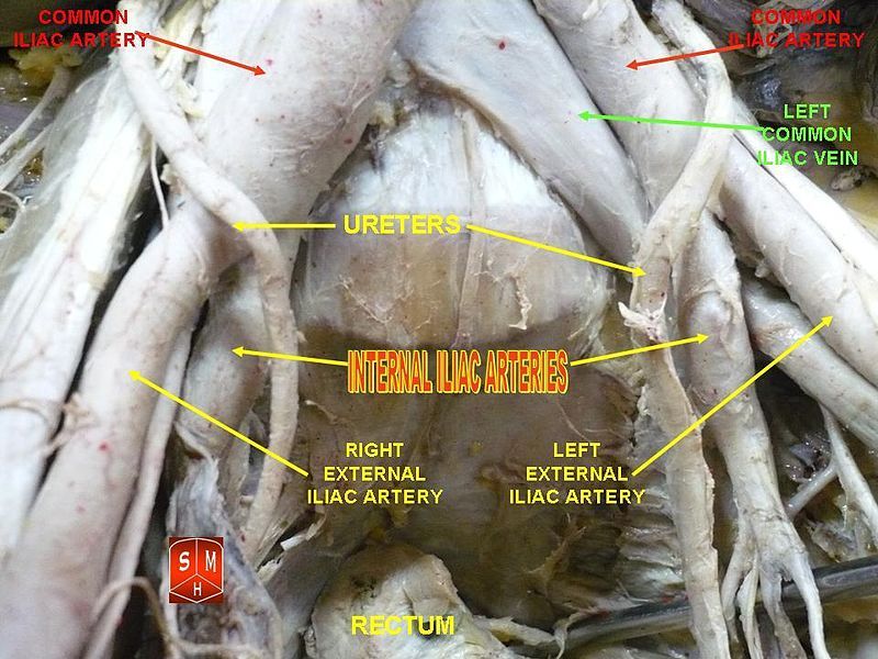 File:Internal iliac arteries.jpg