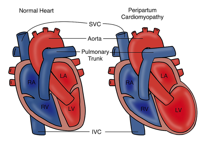 File:Peripartum cardiomyopathy.png