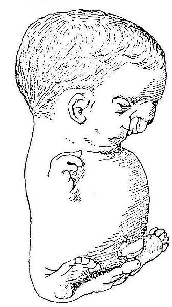 File:Virchow fetus 1898.JPG