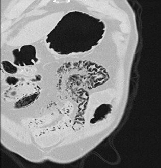 Coronal reformatted MDCT image showing extensive pneumatosis intestinalis in the left upper quadrant small bowel. The pneumatosis is more cystic and nodular in the small bowel in the midline and the right of midline. This patient had a relatively benign presentation without bowel ischemia and was treated conservatively.