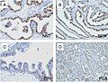 Microscopic examination of different types of prostate tissues (stained with immuno­histochemical techniques): A. Normal (non-neoplastic) prostatic tissue (NNT). B. Benign prostatic hyperplasia. C. High-grade prostatic intraepithelial neoplasia. D. Prostatic adenocarcinoma (PCA).