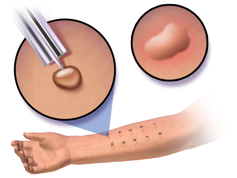 File:Skin Prick Test.png