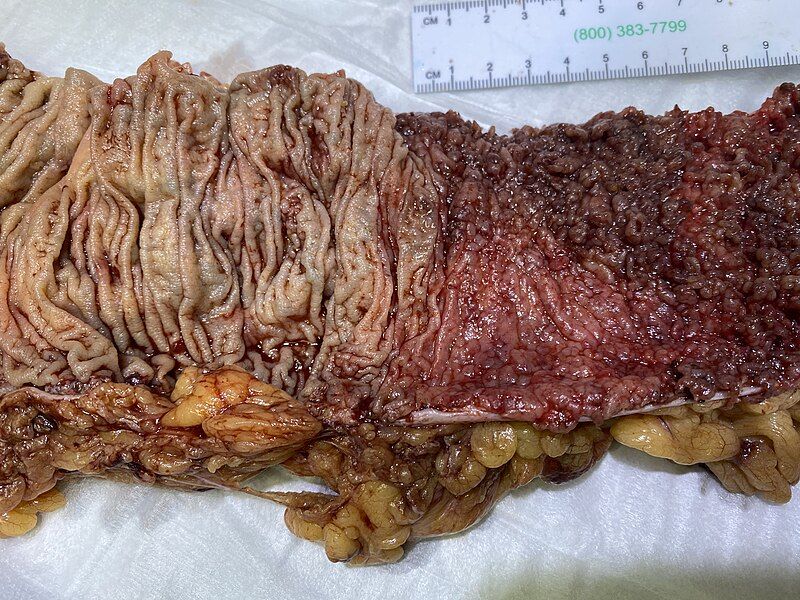 File:Severe ulcerative colitis.jpg