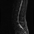 MRI lumbar spine with degeneration (sagittal FAST STIR)