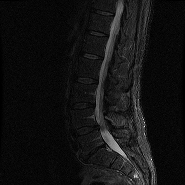 File:SAGITTAL-FAST-STIR-MRI.jpg