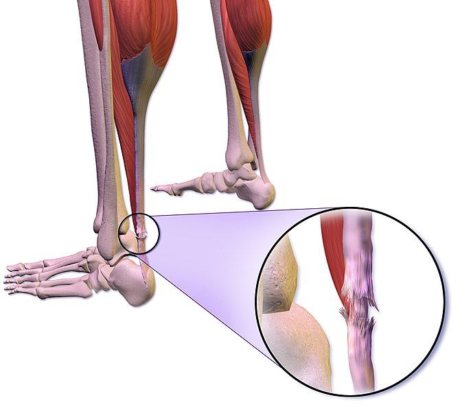 File:Achilles Tendon Rupture.jpg