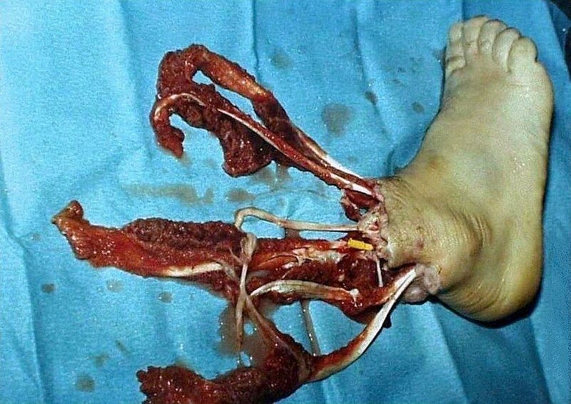 File:Foot Amputation.JPG