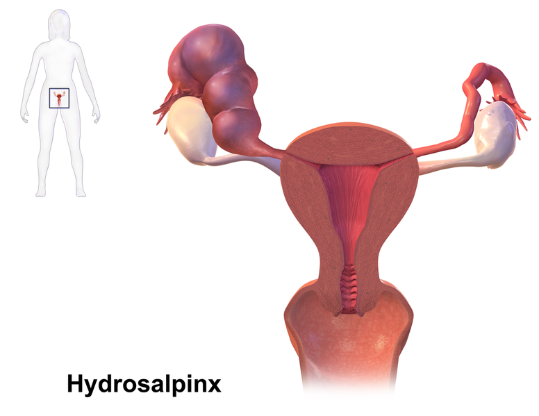 File:Hydrosalpinx.png