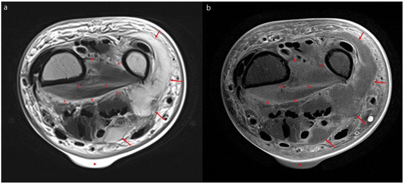 File:Necrotizing fasciitis MRI.png