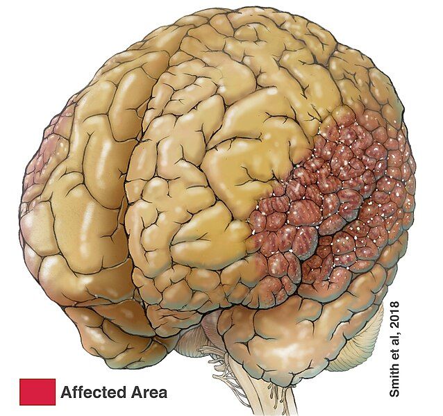 File:Polymicrogyria.jpg