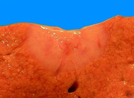 Gross pathologic appearance of a large bile duct hamartoma.