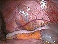 Vermiform appendix