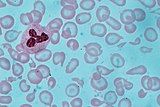 A Giemsa-stained blood film from a person with iron-deficiency anemia. This person also had hemoglobin Kenya.