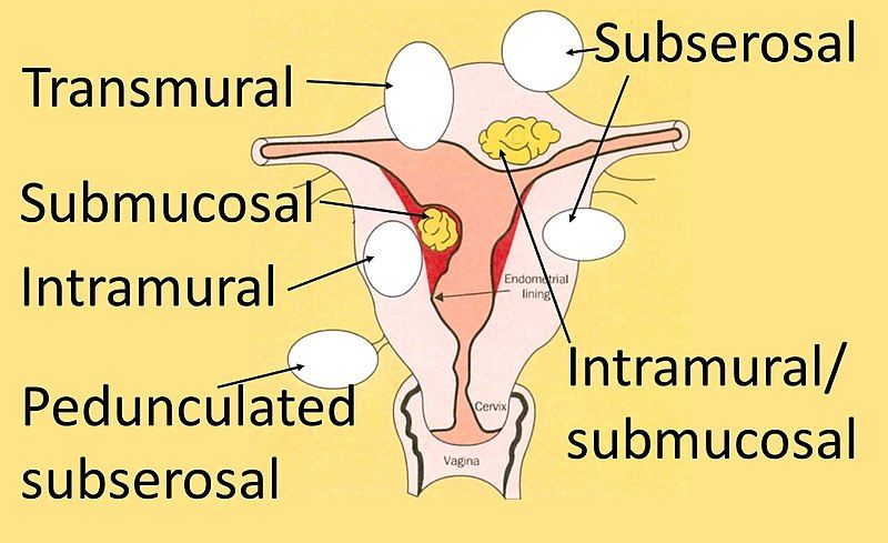 File:Fibroid locations.jpg