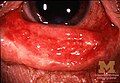 Conjunctivitis in SJS