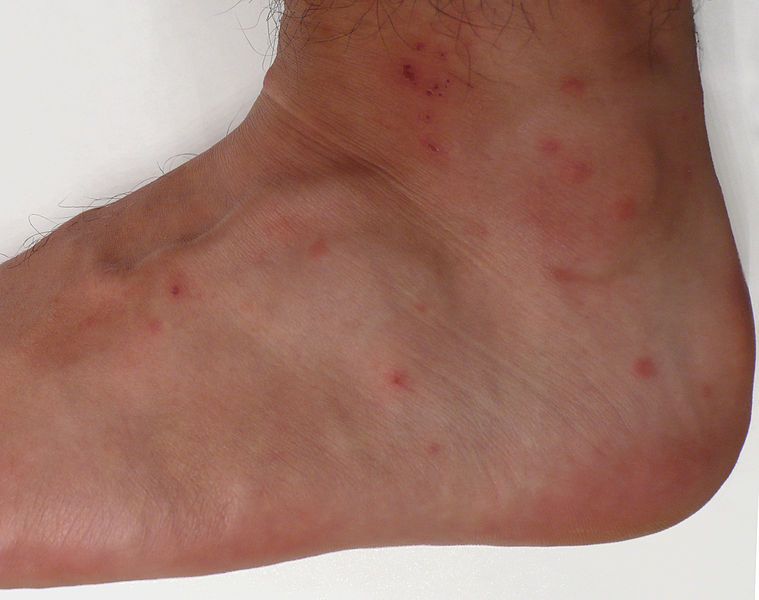 File:Chigger bites.jpg