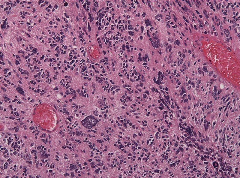 File:Glioblastoma pleomoprhism HE.jpg