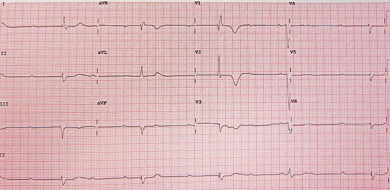 File:CompleteHeartBlock.jpg