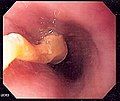 Image of a piece of food obstructing the esophagus