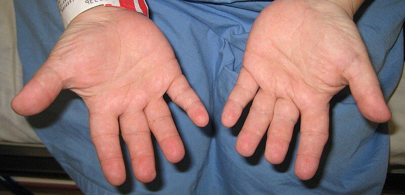 File:Langer-Giedion syndromeHands1.JPG