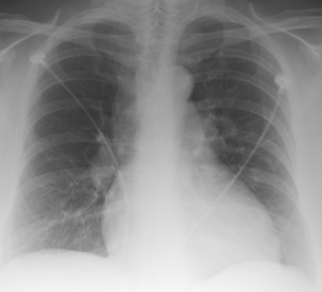 File:AP Chest X-Ray.tif