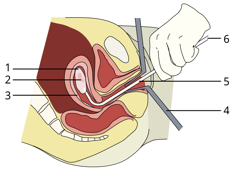 File:Vacuum-aspiration (single).svg