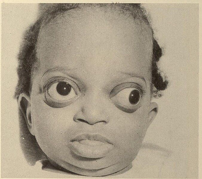 File:Crouzon Syndrome 5.jpg