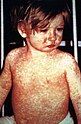 A child with measles