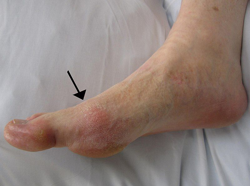 File:Gout2010.JPG