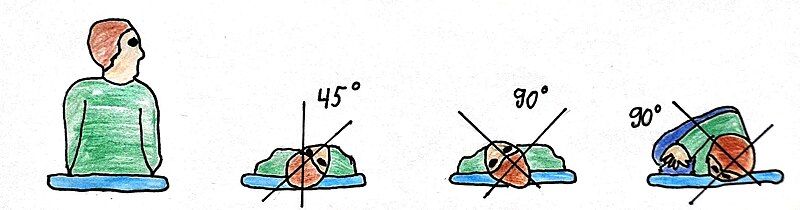 File:Epley maneuver.jpg