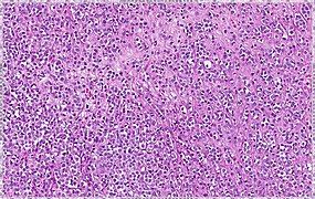 Lobular breast cancer. Single file cells and cell nests.