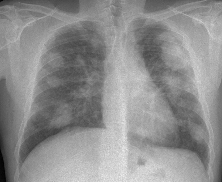 File:Silicosis complicada.jpg